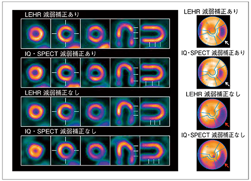 図4　LEHRあるいは，IQ・SPECTで撮像した胸部擬人ファントムの再構成画像の比較
