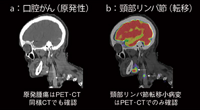 図1　PET･CTによる口腔がん原発巣と頸部リンパ節転移の検出 （画像ご提供：テネシー大学様）