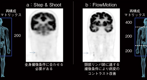 図4　FlowMotionにより，一度の全身撮像内で頭頸部のみ高分解能撮像を行い，頸部リンパ節の描出を改善（画像ご提供：ミシガン大学様）