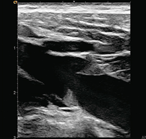 図2　下肢静脈弁の描出