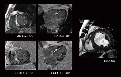非侵襲の心臓MRI検査が可能 3テスラMRI
