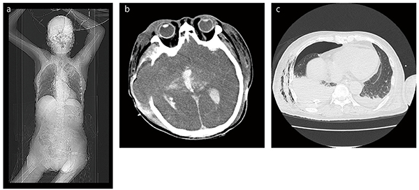 外傷panscan臨床画像：1回のスキャンで広範囲を撮影した症例 a：位置決め画像、b：頭部画像、c：胸部画像