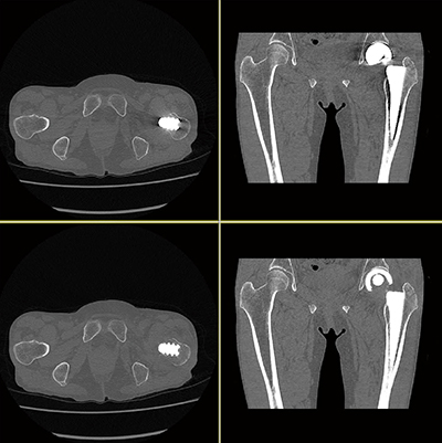 図1　大腿骨転子部骨折症例 SEMARを使用することにより、金属アーチファクトで評価が難しかった骨折線が明瞭に描出できている。