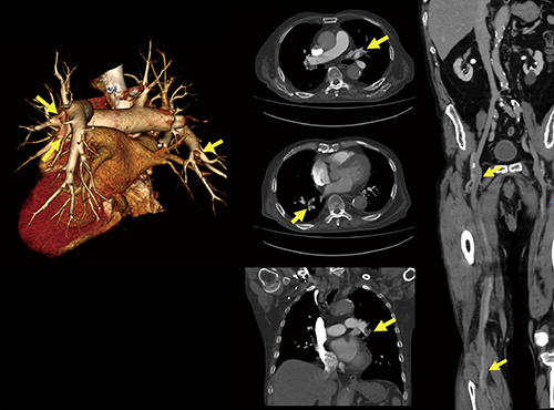 図2　肺塞栓症例 1回の造影で広範囲撮影が可能。肺塞栓および下肢静脈血栓の複数の所見を確認できた。