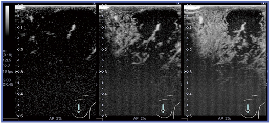 図3　造影超音波のMFI画像 カラードプラで認識し難い腫瘍血管を良好に観察可能