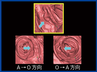 図1　‌症例1の大腸CT画像 肝彎曲部位に表面型病変（Ⅱa + Ⅰs，Adenocarcinoma）を認める。