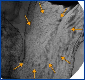 図7　‌バリウムの付着差による病変の描出 表層拡大型胃がん（低異型度癌0 Ⅱb + Ⅱc）