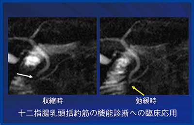 図2　十二指腸乳頭部の収縮・弛緩に伴うMRCP像の変化