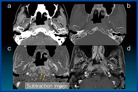 図2　Case1：上咽頭がんの頭蓋底浸潤の評価 a, b：造影CT画像，c：サブトラクション画像， d：脂肪抑制造影MRI画像