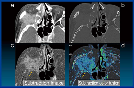 図3　Case2：上顎洞がんの頭蓋底・頭蓋内浸潤の評価 a, b：造影CT画像，c：サブトラクション画像，d：サブトラクションカラーフュージョン