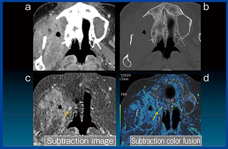 図4　Case2：上顎洞がんの神経周囲進展の評価 a, b：造影CT画像，c：サブトラクション画像，d：サブトラクションカラーフュージョン