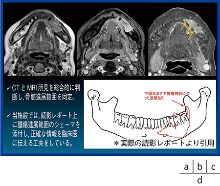 図5　Case3：下歯肉がんの下顎骨切除の術前評価 a，b：造影MRI画像， c：CTサブトラクション画像，d：シェーマ