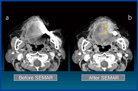図6　Case4：舌がん（左舌縁），T4a a：SEMAR適用前，b：SEMAR適用後