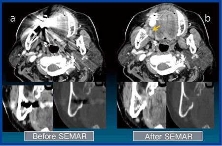 図7　Case5：右臼後部がん　T4a a：SEMAR適用前，b：SEMAR適用後