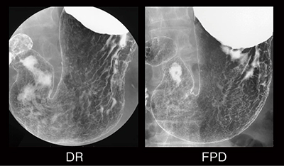 図2　4M-DRとFPDの比較 早期胃癌，0- II c，M，35mm（2002年）