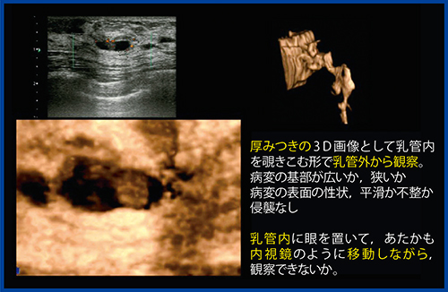 図2　厚みつき画像によるバーチャル乳管造影・内視鏡像