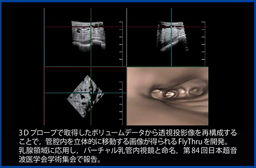 図3　初期のFlyThruによる授乳期拡張乳管像