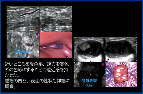 図7　遠近表現の改善による乳管および腫瘤の描出