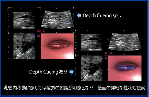 図8　乳管内移動における遠近表現の改善