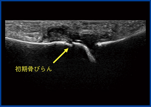 図5　症例2：第2趾MTP関節炎のBモード画像