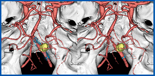 図7　脳動脈瘤コイル塞栓術後のSEMAR併用3D CTA