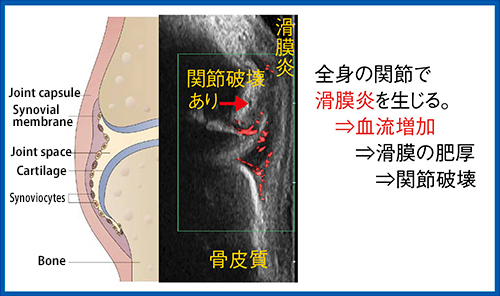 図1　滑膜炎の超音波画像の特徴