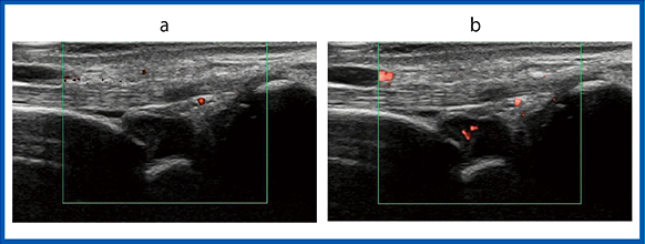 図5　症例4：左手関節橈側の滑膜炎
