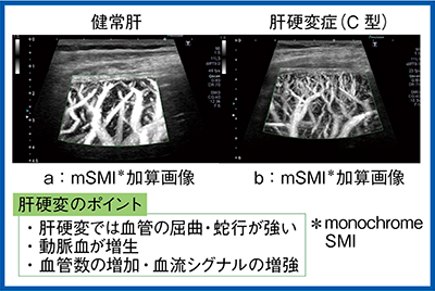 図1　健常肝と肝硬変症の血管構築の比較（mSMI加算画像）