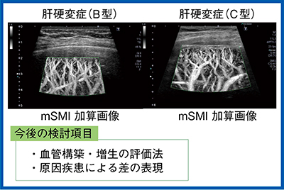 図2　原因による肝硬変症の血管構築の比較（mSMI加算画像）