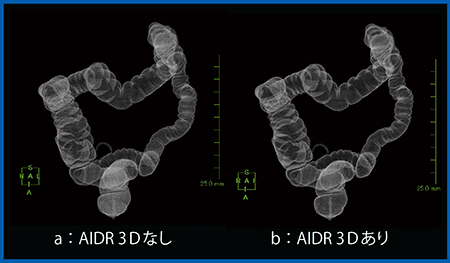 図2　症例1：仮想注腸画像（BMI 30.9の体格の大きい被検者）