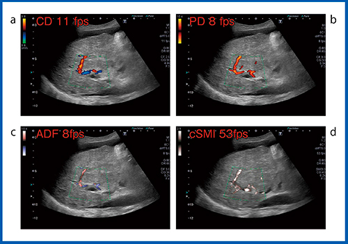 図1　SMI（d）とカラードプラ（a），パワードプラ（b），ADF（c）との比較（門脈血栓症）