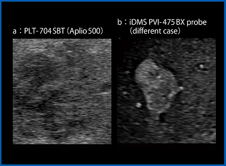 図6　肝血管腫におけるPLT-704SBT（a）とiDMS PVI-475BX（b）の比較