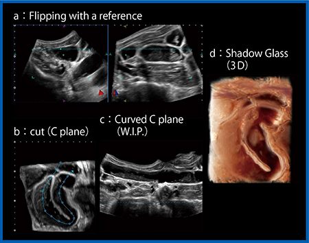 図11　単純性腸閉塞におけるCurved C plane（W.I.P.）（c）とShadow Glass（d）の有用性