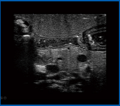 図18　小児の胆道閉鎖症におけるiDMS PLI-2004BX（20MHz）を用いた胆管の描出