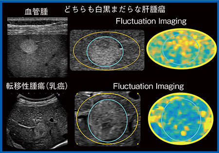 図3　Fluctuation Imaging（W.I.P.）による肝腫瘤の鑑別