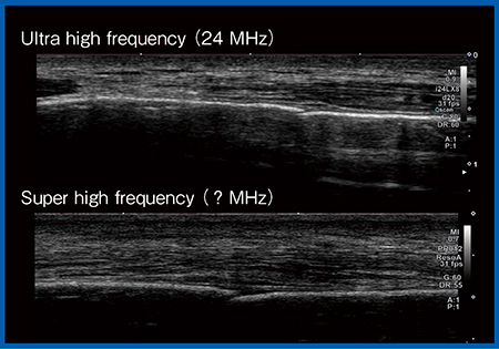 図12　肋骨骨折の描出 a：Ultra High Frequency Probe（24MHz） b：Super High Frequency Probe