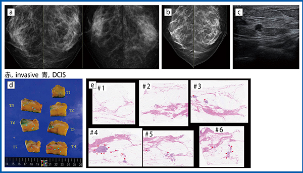 図2　症例2：初期のHER2陽性乳がん a：マンモグラフィ画像　b：トモシンセシス画像　c：Bモード画像　d：切除標本　e：病理像
