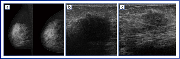 図3　症例3：乳腺線維症 a：マンモグラフィ画像　b：従来超音波診断装置のBモード画像　c：Aplio i800のBモード画像