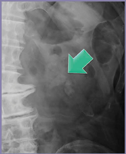 図2　症例1：腹部単純X線画像 わずかに淡く描出される左腎孟結石（←）