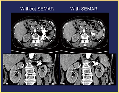 図2　SEMARの有無による金属アーチファクトの比較 SEMARを用いると，膵臓付近のアーチファクトが顕著に軽減されている。