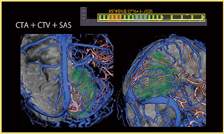 図4　症例4：膠芽腫 動脈，静脈と腫瘍の位置関係の把握