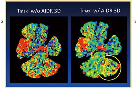 図3　Case2：CTP解析におけるAIDR 3Dの効果 a：オリジナル，b：AIDR 3Dを適用