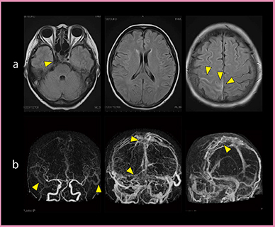 図4　症例1：静脈洞血栓症 a：MRI（FLAIR）　b：Aquilion ONEの4D-CTA