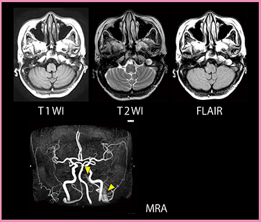 図5　症例2：TIAを伴う静脈洞血栓症（MRI）