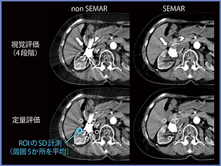図5　動脈瘤のコイル塞栓術後評価におけるSEMARの役割4）