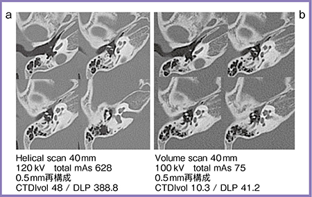 図1　症例1：鼓膜形成術前後の聴器CT（6歳，男児） a：Aquilion 64で撮影した術前画像 b：Aquilion ONEで撮影した術後画像