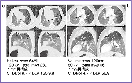 図2　症例２：先天性気管支閉鎖症（胎児診断例） a：Aquilion 64で撮影した日齢3，2.7kgの画像 b：Aquilion ONEで撮影した8か月，8kgの画像