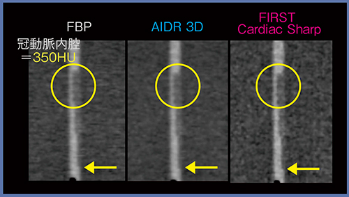図1　350HUでのFBP，AIDR 3D，FIRST（Cardiac Sharp）のプラークの描出