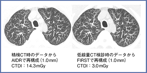 図7　症例6：肺がん検診例（60歳代，男性）