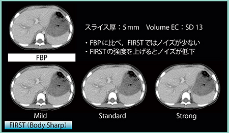 図4　FBPとFIRST Body Sharpの画質の比較（1歳，劇症肝炎）